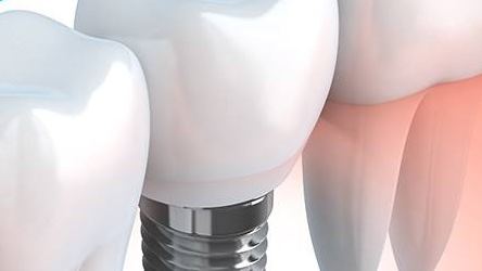 implant-800x250
